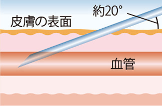 画像：血管への針の刺し方