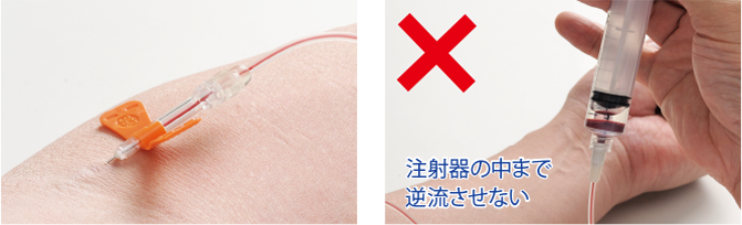 画像：血液の逆流の確認